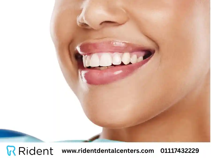 تعرف على مميزات وانواع هوليود سمايل أو ابتسامة هوليود